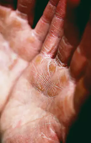 signs of dehydration